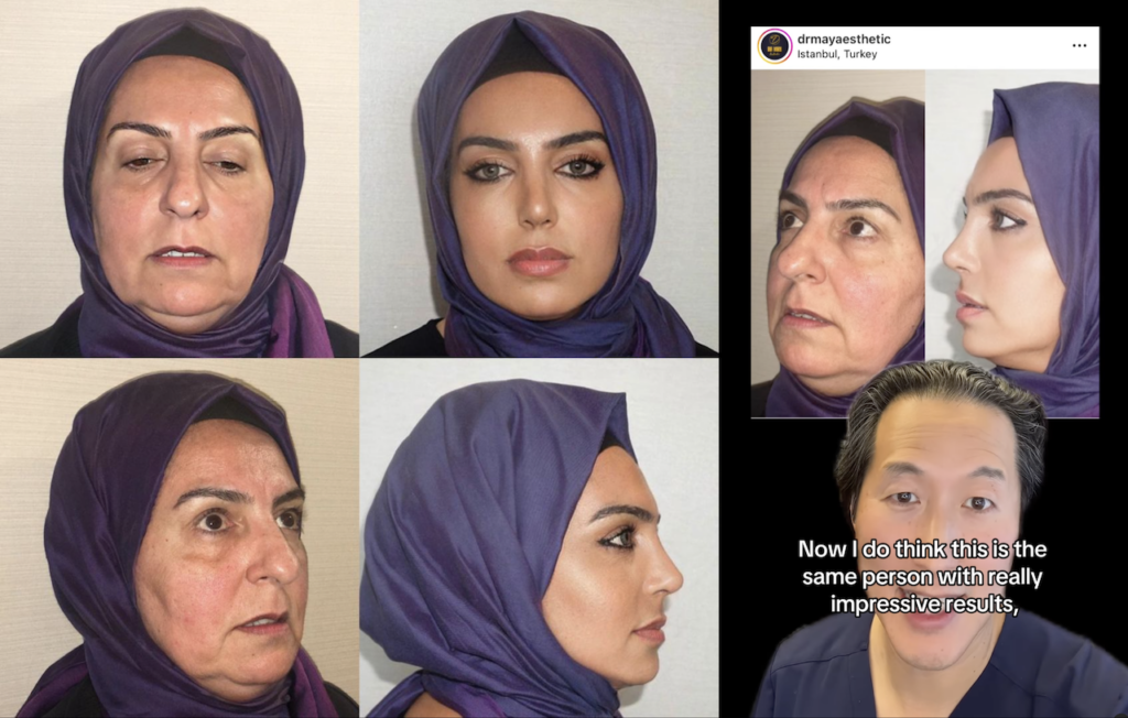 Dr. Anthony Youn says viral Turkish facelift pics are the same person, with really incredible results.